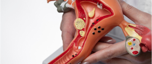 Fibroids