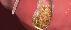 Health Maintenance for Gallstones