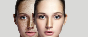 Hyperpigmentation Treatment at Heritage Hospital