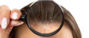 Scalp Infections