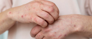 Skin Infections