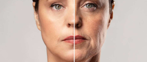 Skin Tightening