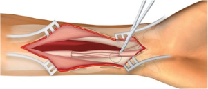 Spinal Surgery