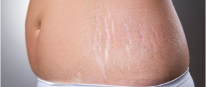 Stretch Mark Treatment