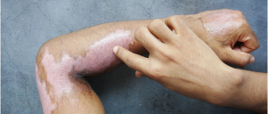 Vitiligo Treatment at Heritage Hospital