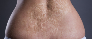 Burn Reconstruction
