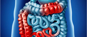 Irritable Bowel Syndrome