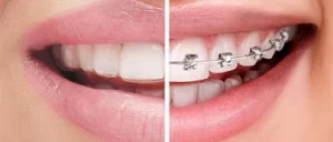 Aligners & Braces at Heritage IMS Hospital